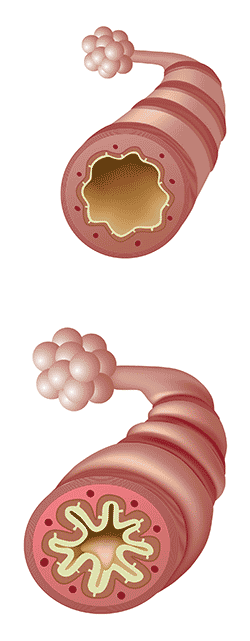 schéma d'une bronche normale et d'une bronche ashtmatique - EMOA Mutuelle